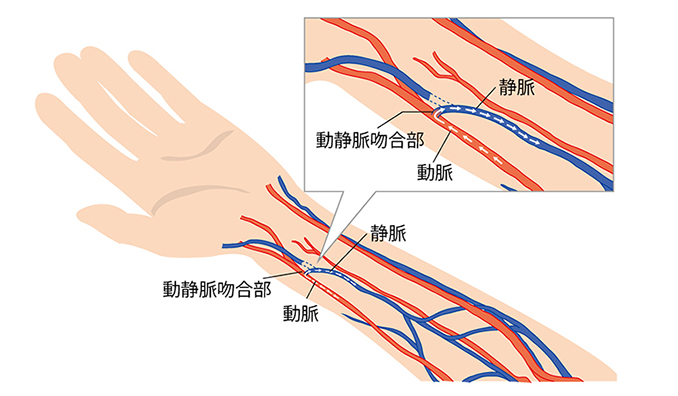 シャント マッサージ の 仕方