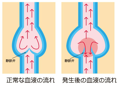 下肢静脈瘤とは