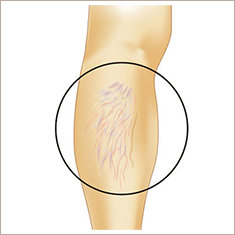 クモの巣状静脈瘤